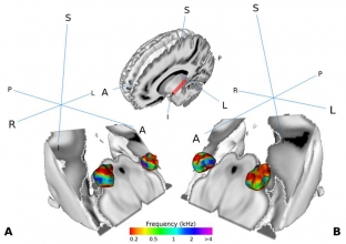 Darstellung des medialen Kniehöckers im Gehirn von menschlichen Testpersonen.  Copyright: Mihai et al. 2019, CC-BY license
