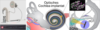 Konzeptzeichnung der Kombination von optischem Cochlea-Implanta